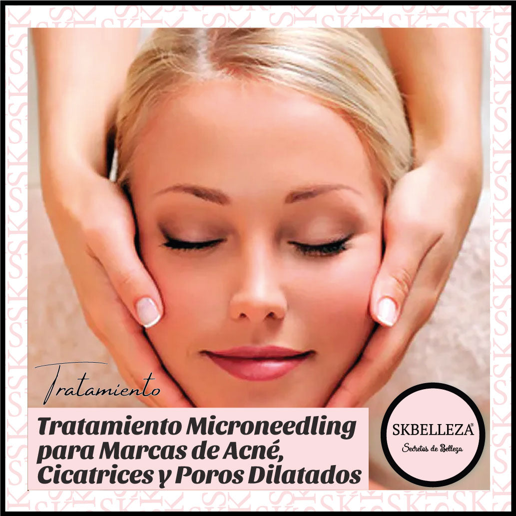 Tratamiento Microneedling para Marcas de Acné, Cicatrices y Poros Dilatados